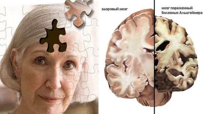 Уход за больными Альцгеймера