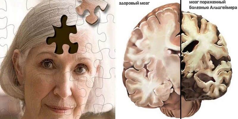 bolez-alcgz Уход за больными Альцгеймера